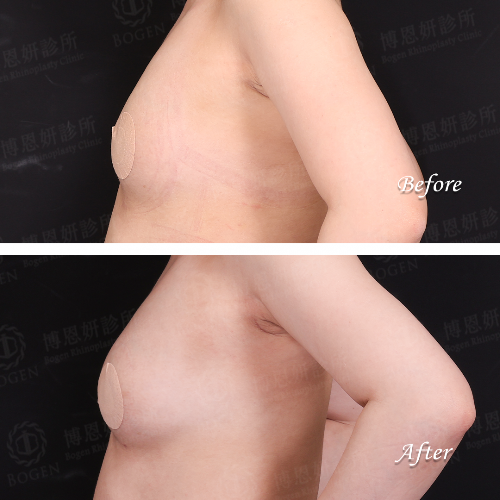 自體脂肪移植,自體脂肪移植胸部,自體脂肪移植隆乳,博恩妍